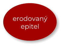 erodovaný epitel